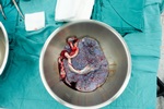 Placenta